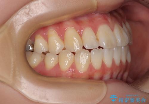 舌の突出癖が原因　インビザライン矯正による開咬改善の治療後
