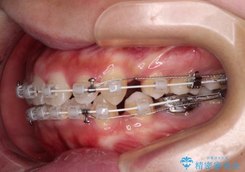口ゴボが気になる 上下4本の抜歯矯正の治療中
