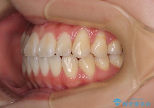 舌の突出癖が原因 インビザライン矯正による開咬改善の治療後