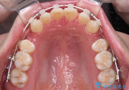 口ゴボが気になる 上下4本の抜歯矯正の治療中
