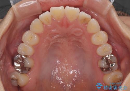 舌の突出癖が原因　インビザライン矯正による開咬改善の治療後