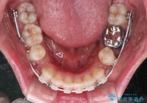 口ゴボが気になる 上下4本の抜歯矯正の治療中
