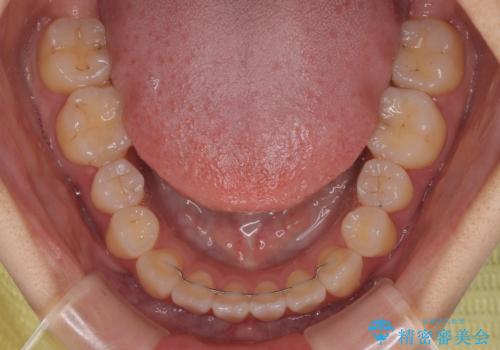 舌の突出癖が原因 インビザライン矯正による開咬改善の治療後