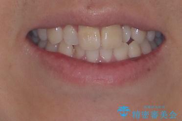 マウスピース矯正と迷った結果…管理のしやすさで選んだクリアブラケット矯正の症例の治療前(顔貌)