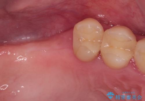 かかりつけ医の治療方針に疑問　歯周病治療と矯正治療を合わせた総合歯科治療の治療前