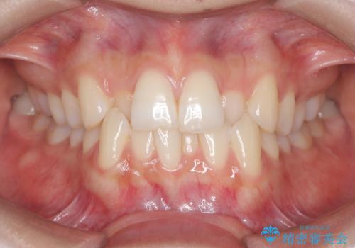 1年でここまで変わる。デコボコ歯並びの非抜歯矯正!の治療前