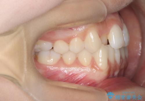 1年でここまで変わる。デコボコ歯並びの非抜歯矯正!の治療前