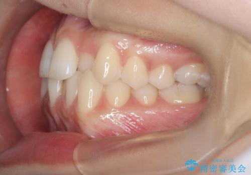 1年でここまで変わる。デコボコ歯並びの非抜歯矯正!の治療前