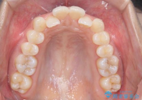 1年でここまで変わる。デコボコ歯並びの非抜歯矯正!の治療前
