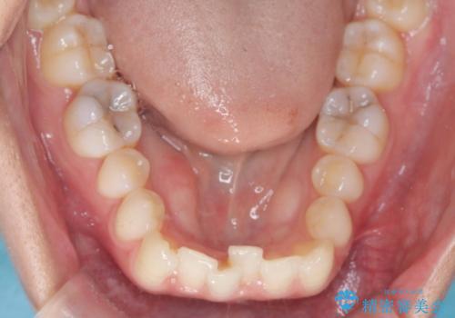 1年でここまで変わる。デコボコ歯並びの非抜歯矯正!の治療前