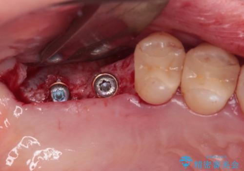 かかりつけ医の治療方針に疑問　歯周病治療と矯正治療を合わせた総合歯科治療の治療中