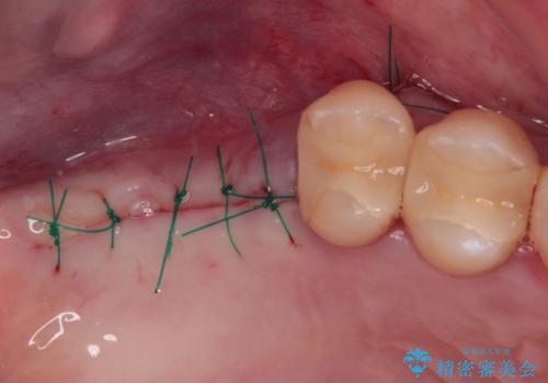 かかりつけ医の治療方針に疑問　歯周病治療と矯正治療を合わせた総合歯科治療の治療後