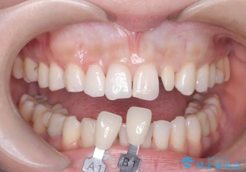 矯正後、矮小歯をオールセラミッククラウンで審美修復の治療中