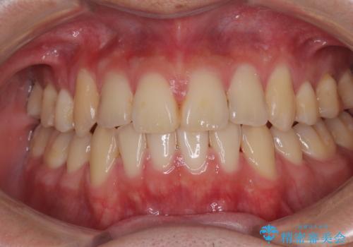 矯正治療の後戻り　インビザライン・モデレートパッケージで短期間治療の治療中