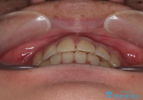 矯正治療の後戻り インビザライン・モデレートパッケージで短期間治療の治療中