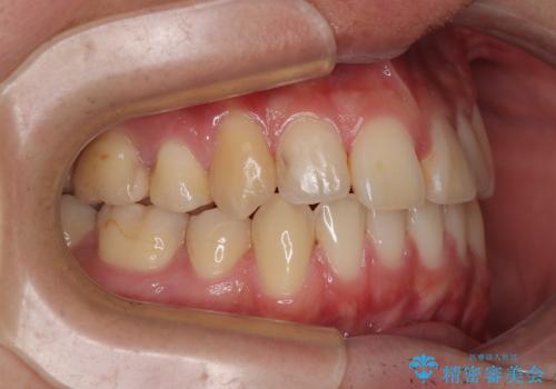 矯正治療の後戻り　インビザライン・モデレートパッケージで短期間治療の治療中