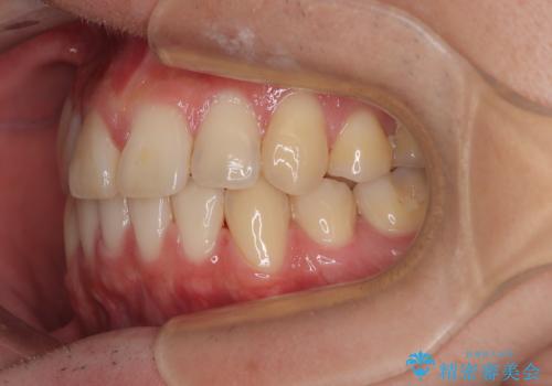 矯正治療の後戻り インビザライン・モデレートパッケージで短期間治療の治療中