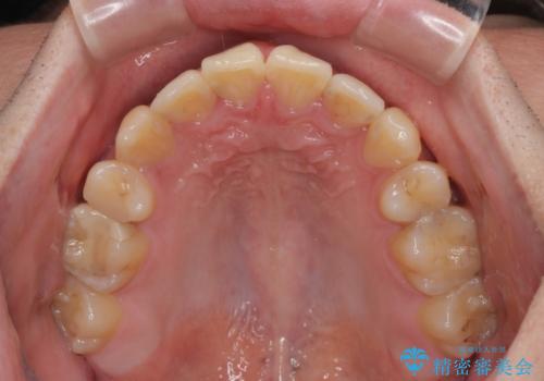 矯正治療の後戻り　インビザライン・モデレートパッケージで短期間治療の治療中