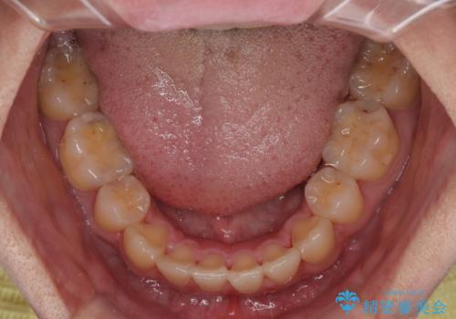 矯正治療の後戻り インビザライン・モデレートパッケージで短期間治療の治療中