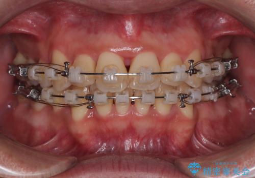矯正治療途中で転院　遠方への転勤で通院困難な方の矯正治療の治療中