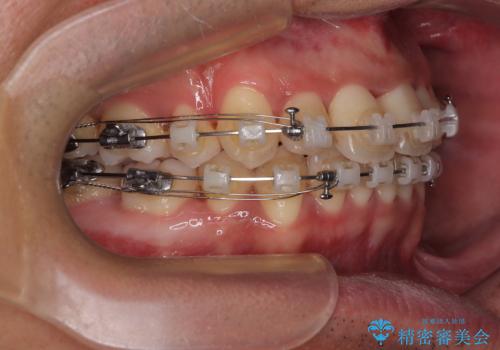 矯正治療途中で転院　遠方への転勤で通院困難な方の矯正治療の治療中
