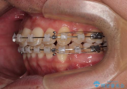 矯正治療途中で転院　遠方への転勤で通院困難な方の矯正治療の治療中