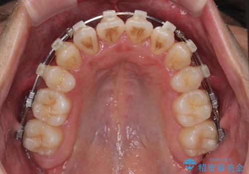矯正治療途中で転院　遠方への転勤で通院困難な方の矯正治療の治療中