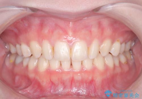 オフィスホワイトニングの治療中