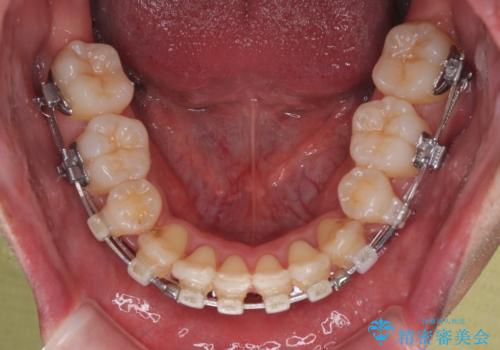 矯正治療途中で転院　遠方への転勤で通院困難な方の矯正治療の治療中