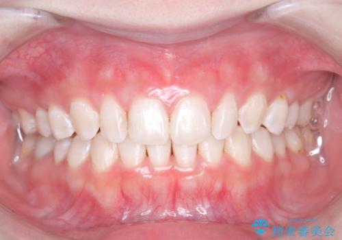 オフィスホワイトニングの治療後