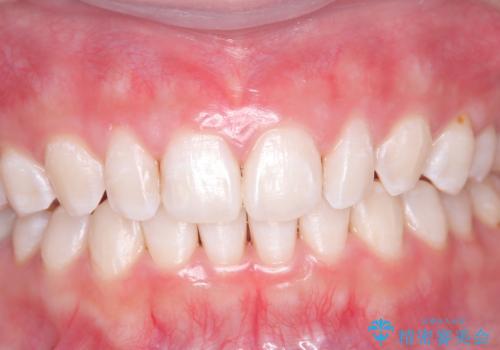 オフィスホワイトニング