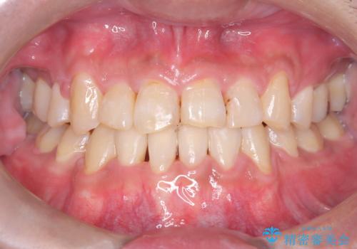 【ワイヤー矯正】かみ合わせを治したいの治療後
