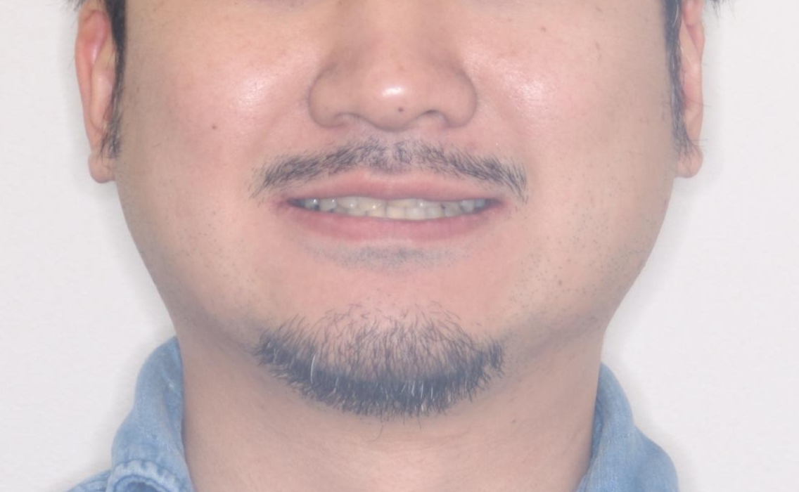 【ワイヤー矯正】かみ合わせを治したいの治療後(顔貌)