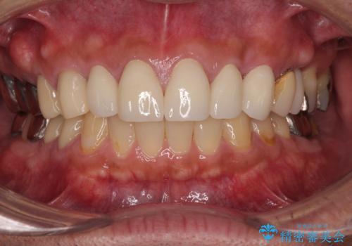 前歯のコンプレックスを解消|40代男性・オールセラミッククラウン症例の治療後