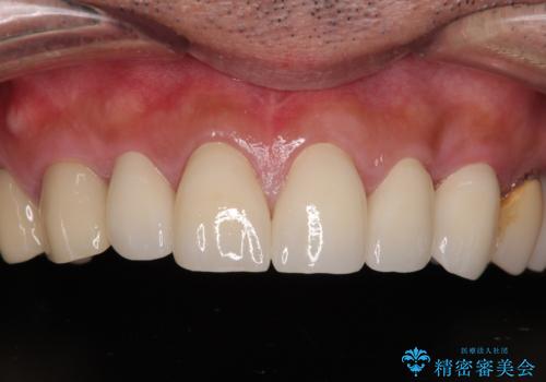 前歯のコンプレックスを解消|40代男性・オールセラミッククラウン症例の治療後