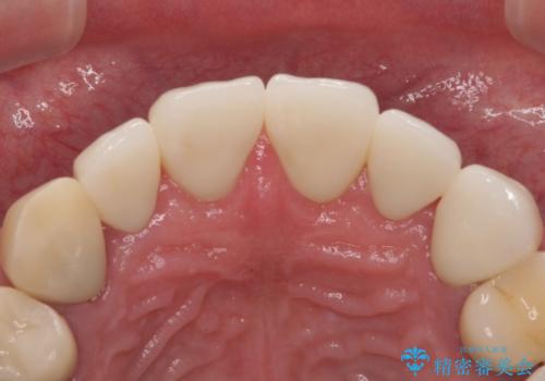 前歯のコンプレックスを解消|40代男性・オールセラミッククラウン症例の治療後