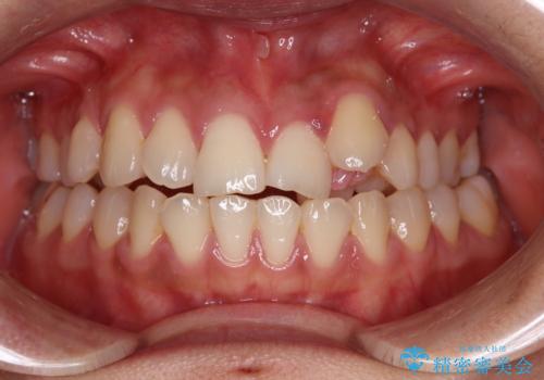 急速拡大装置　狭い上顎歯列を改善して、八重歯を改善した片側抜歯矯正治療の治療前