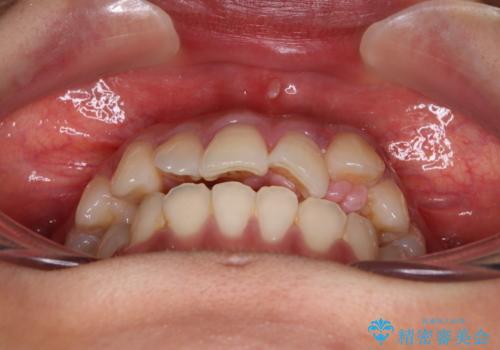 急速拡大装置　狭い上顎歯列を改善して、八重歯を改善した片側抜歯矯正治療の治療前