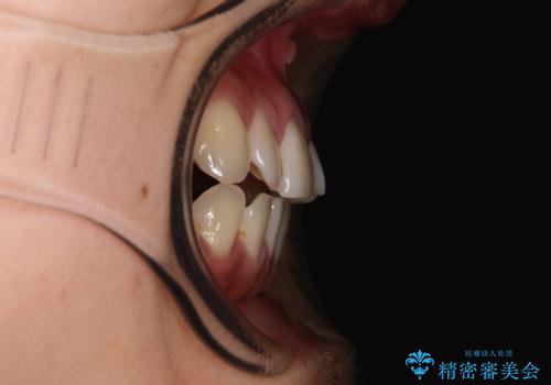 急速拡大装置 狭い上顎歯列を改善して、八重歯を改善した片側抜歯矯正治療の治療前