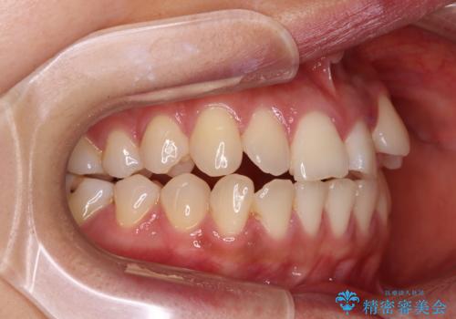 急速拡大装置　狭い上顎歯列を改善して、八重歯を改善した片側抜歯矯正治療の治療前