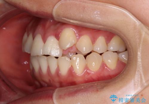急速拡大装置 狭い上顎歯列を改善して、八重歯を改善した片側抜歯矯正治療の治療前