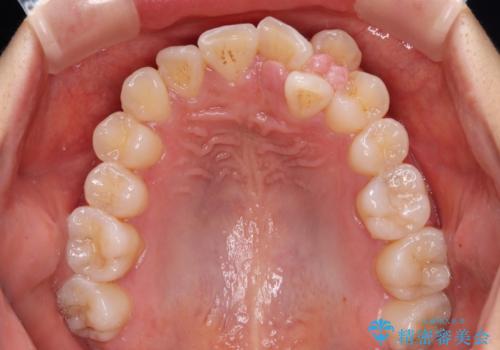 急速拡大装置　狭い上顎歯列を改善して、八重歯を改善した片側抜歯矯正治療の治療前