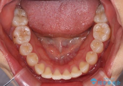 急速拡大装置 狭い上顎歯列を改善して、八重歯を改善した片側抜歯矯正治療の治療前