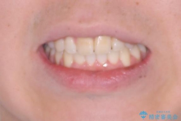 マウスピース矯正と迷った結果…管理のしやすさで選んだクリアブラケット矯正の症例の治療後(顔貌)