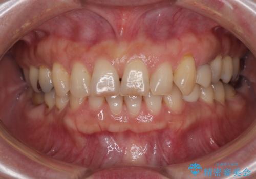 ぐらつく乳犬歯を抜歯即時インプラントで短期間に機能回復の治療後