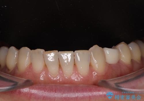 ぐらつく乳犬歯を抜歯即時インプラントで短期間に機能回復の治療後