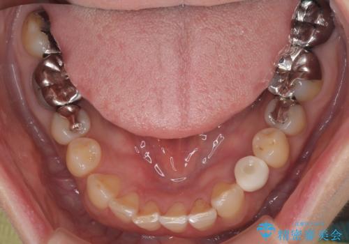 ぐらつく乳犬歯を抜歯即時インプラントで短期間に機能回復の治療後