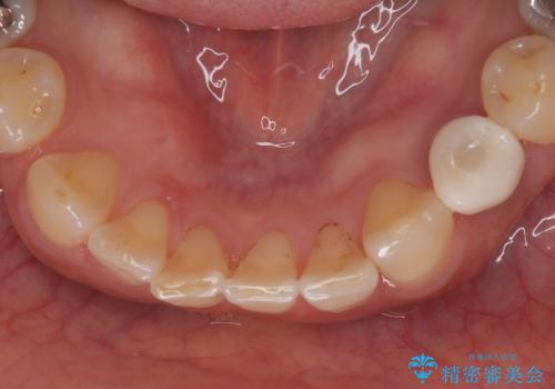 ぐらつく乳犬歯を抜歯即時インプラントで短期間に機能回復の治療後