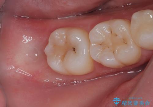 親知らずを抜きたい　親知らず抜歯の症例 治療前
