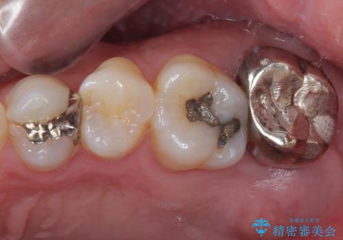 腫れて痛む奥歯　抜歯を覚悟した歯のむし歯治療の症例 治療前